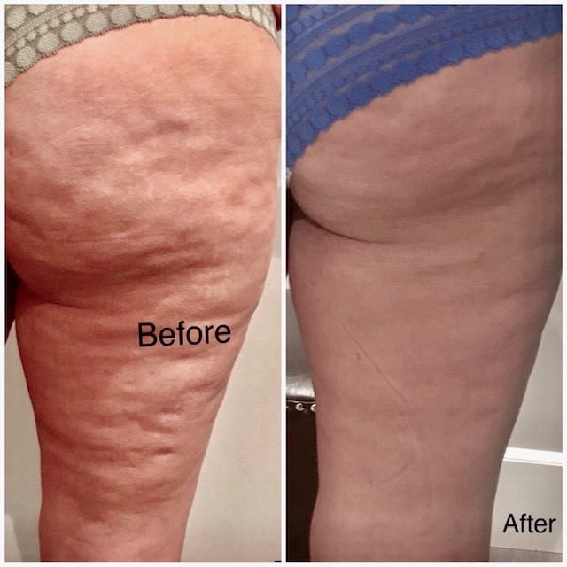 Does Sauna Red Light Therapy Really Work for Cellulite?