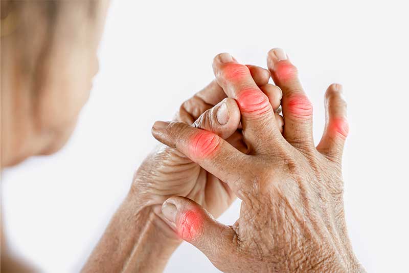 The Power of Ice Baths for Arthritis: An Evidence-Based Overview