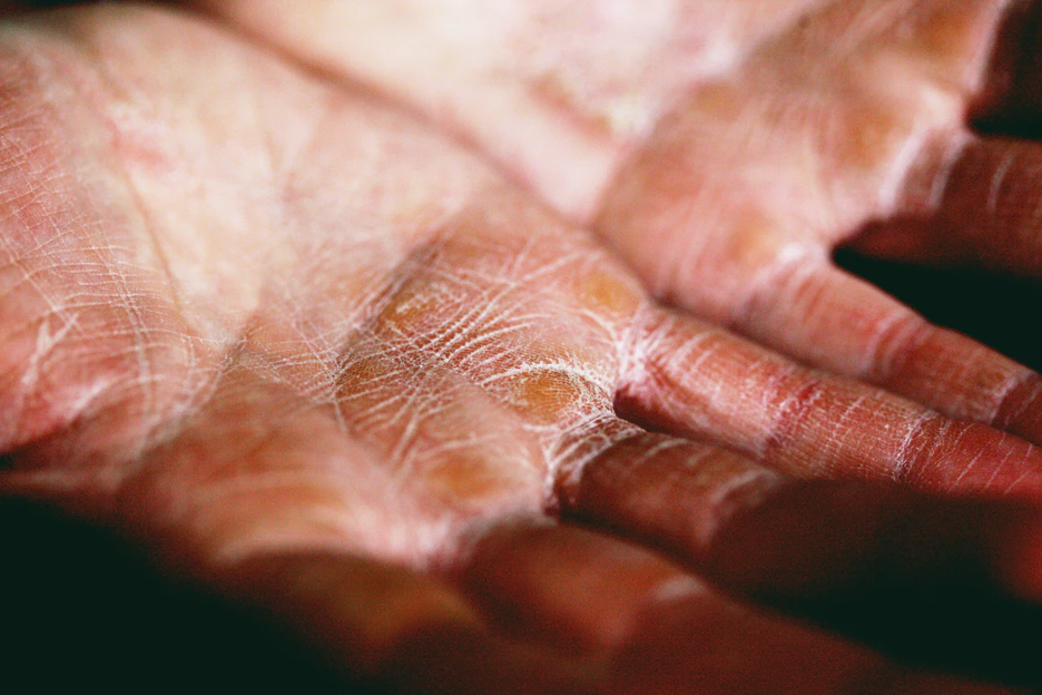 The Top Benefits of Red Light Therapy for Eczema
