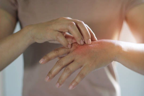Infrared Sauna Health Benefits for Psoriasis Relief