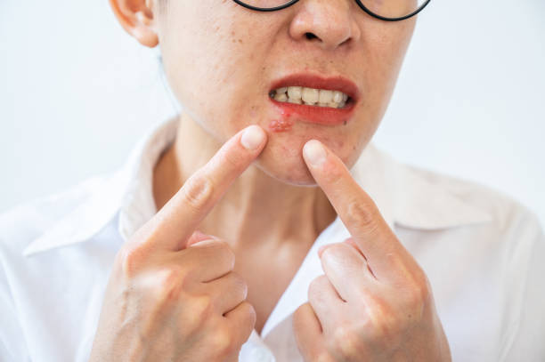 Can Red Light Therapy Heal Cold Sores Faster?