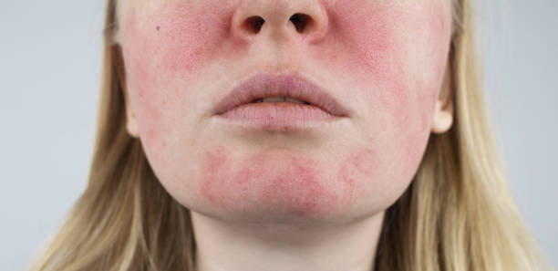 Rosacea and light therapy