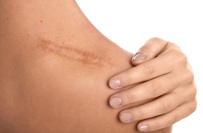 Does Red Light Therapy Help Heal Scars?